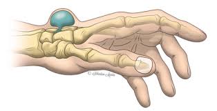 Traumatologie du poignet Cabinet orthopédique à Royan